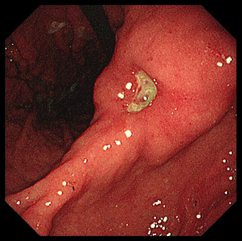 胃・十二指腸潰瘍