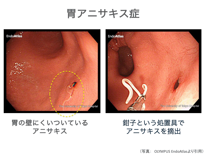 胃アニサキス症