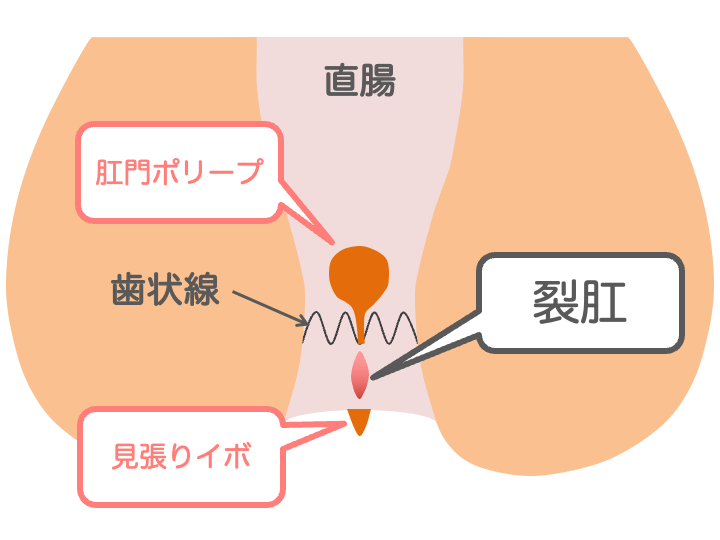 裂肛（切れ痔）の症状のイメージ画像