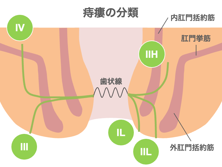 痔瘻の分類のイメージ画像