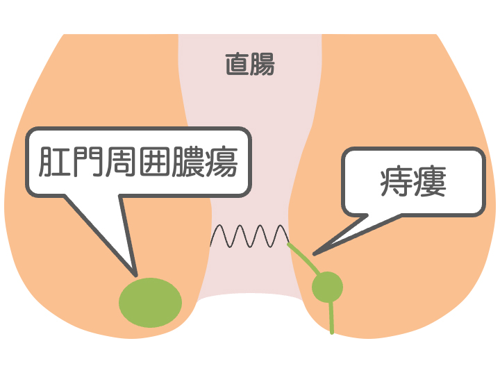 血栓性外痔核のイメージ画像