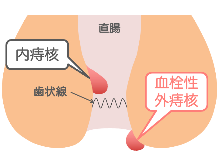 血栓性外痔核のイメージ画像