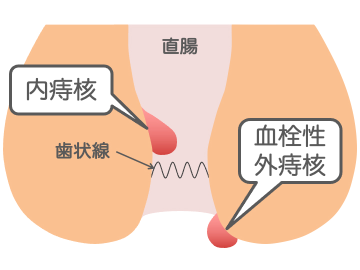 痔核（いぼ痔）