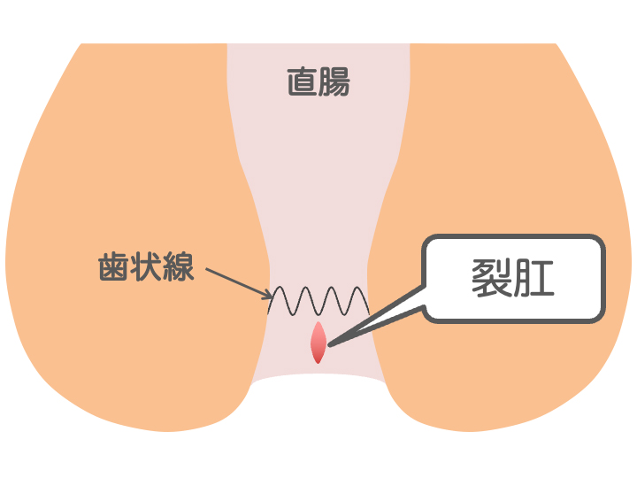 裂肛（切れ痔）