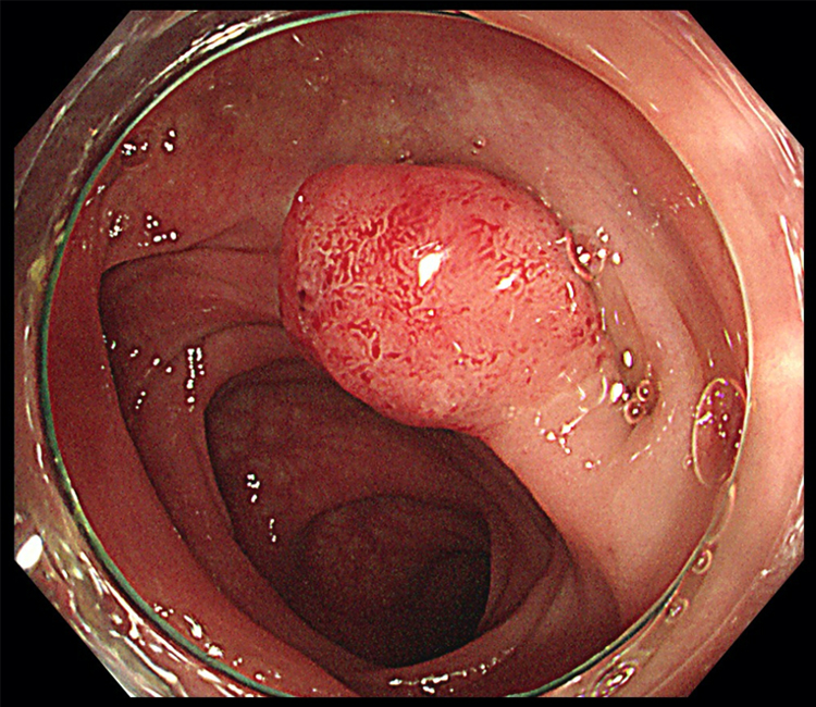 大腸ポリープ