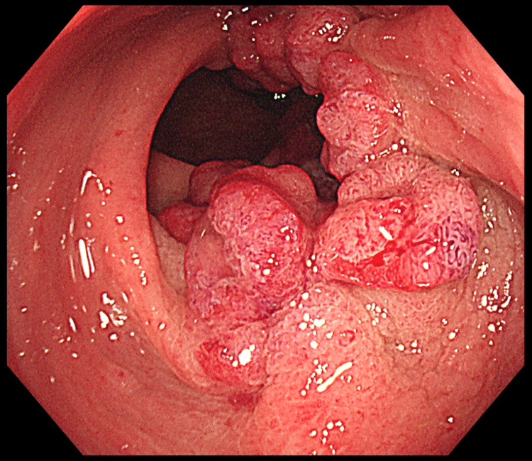 おしりから出血したときには『大腸がん』に要注意！