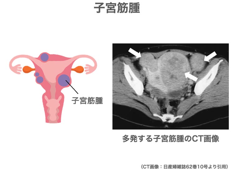婦人科系の疾患