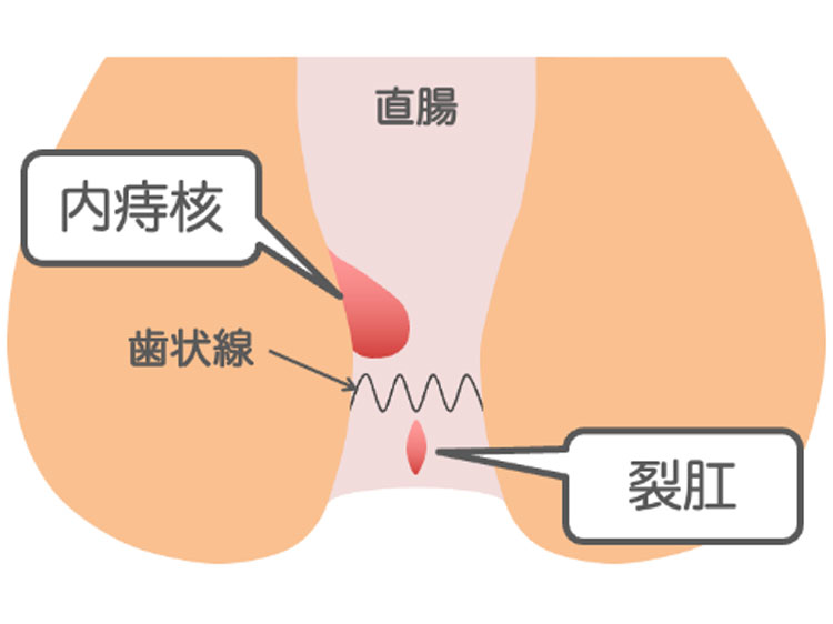 便潜血陽性の原因のイメージ画像