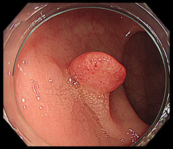 大腸ポリープ（腺腫）の内視鏡検査写真のイメージ画像