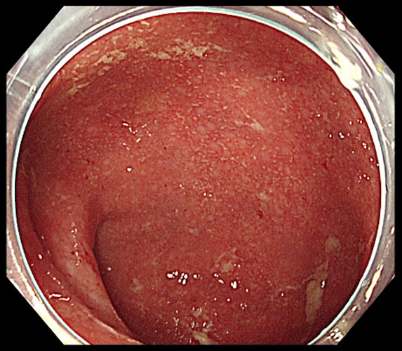 潰瘍性大腸炎の内視鏡検査写真のイメージ画像