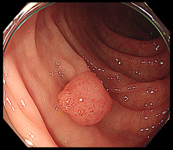 早期大腸がんの内視鏡検査写真のイメージ画像