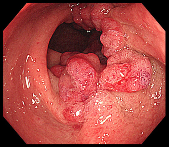 進行大腸がんの内視鏡検査写真のイメージ画像