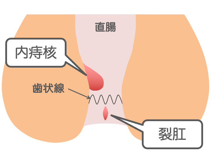 痔（いぼ痔、切れ痔）のイメージ画像