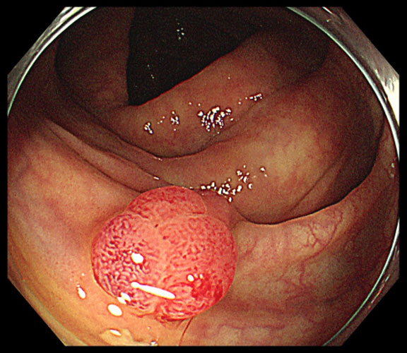 大腸ポリープのイメージ画像