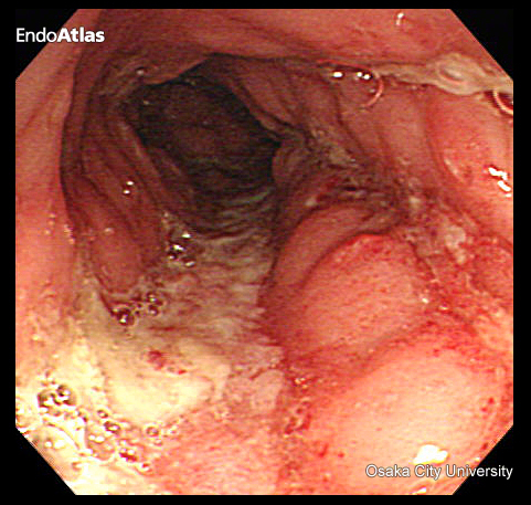 クローン病のイメージ画像