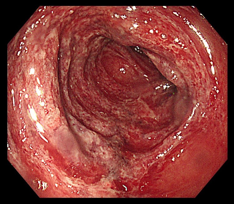 虚血性腸炎のイメージ画像
