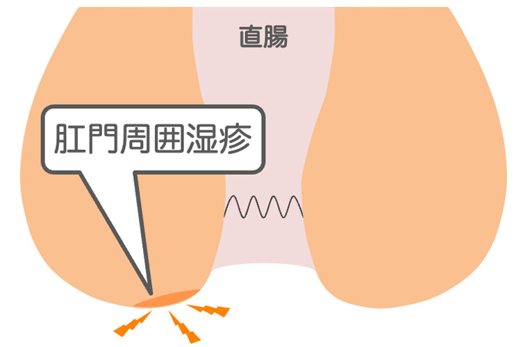 肛門周囲の皮膚炎・湿疹