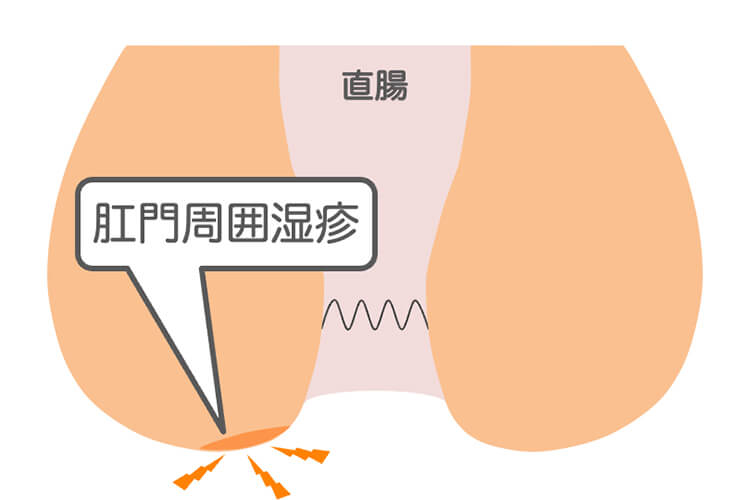 肛門周囲皮膚炎・肛門周囲湿疹