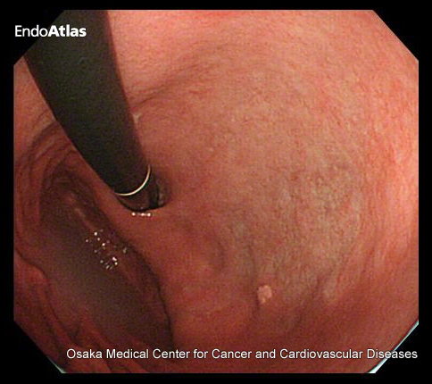 【慢性胃炎（萎縮性胃炎）の内視鏡検査写真】（OLYMPUS EndoAtlasより引用）