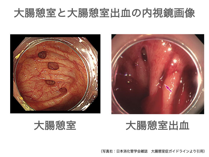 大腸憩室出血とは？