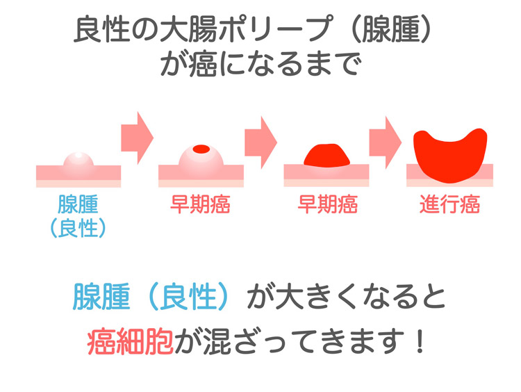 良性の大腸ポリープ（腺腫）が癌になるまでイラスト図 | 腺腫（良性）が大きくなると癌細胞が混ざってきます！