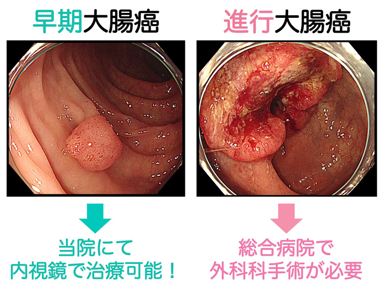 早期大腸癌 → 当院にて内視鏡で治療可能！ | 進行大腸癌 → 総合病院で外科手術が必要
