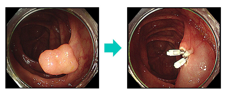 ポリープ切除イメージ画像
