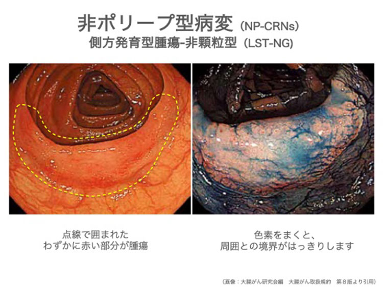 近年注目されている非ポリープ型の病変（NP-CRNs）のイメージ画像