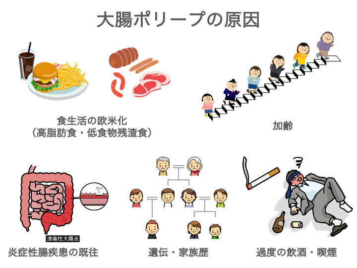 大腸ポリープの原因は？のイメージ画像