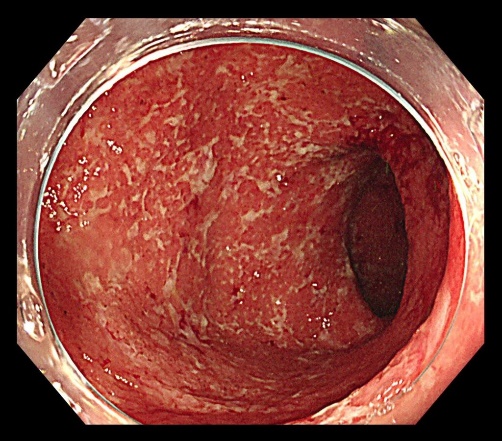 炎症性腸疾患（IBD）のイメージ画像