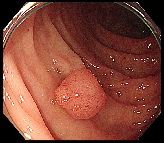 大腸内視鏡検査のイメージ画像