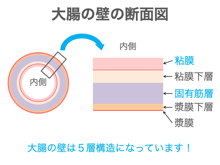 大腸がんの進行度（ステージ）のイメージ画像