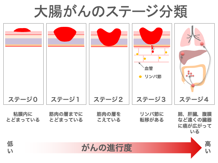 大腸がんのステージ分類のイメージ画像