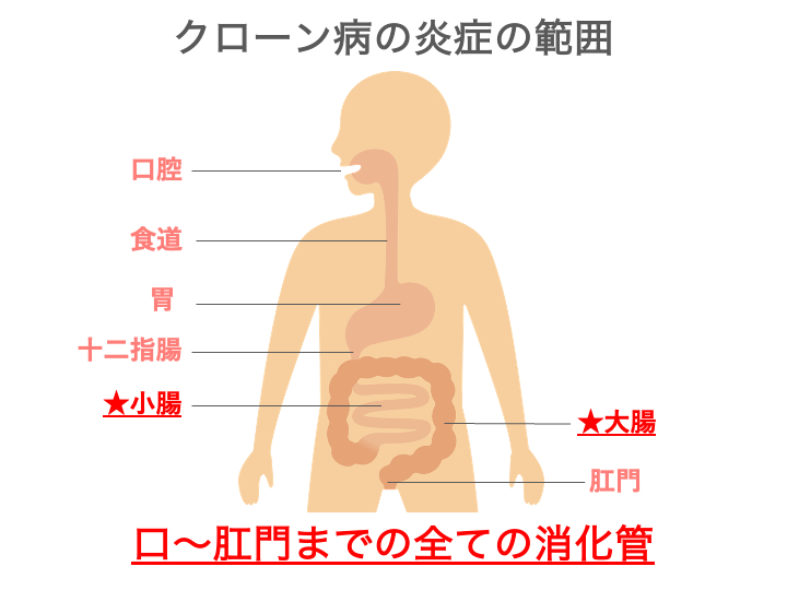 クローン病の炎症の範囲