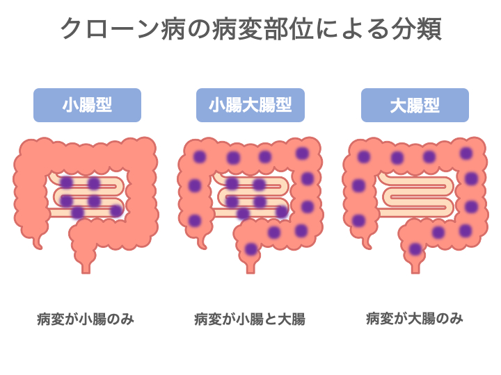 クローン病の炎症の範囲
