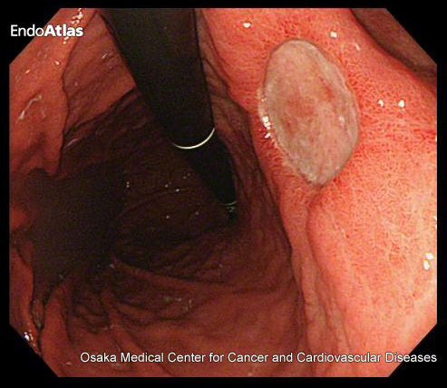 胃内視鏡検査（胃カメラ）