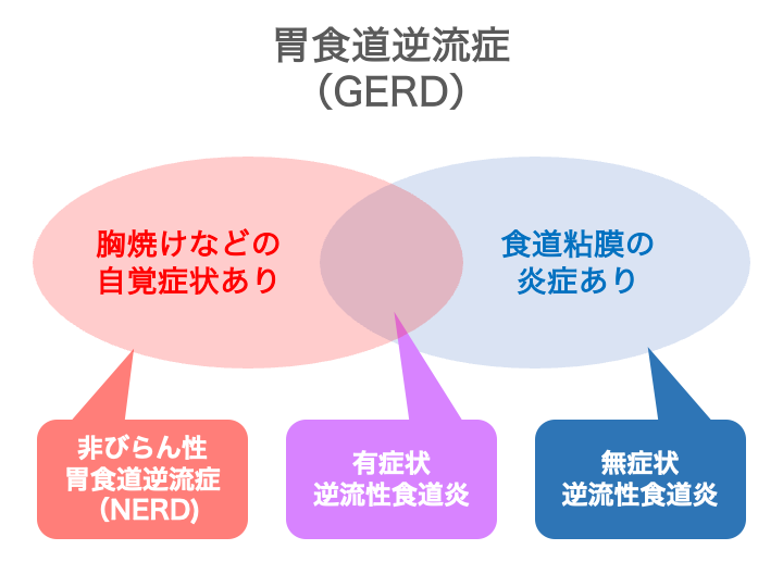 胃食道逆流症と逆流性食道炎の違いは？