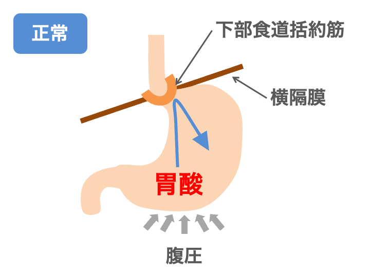 胃食道逆流症の原因