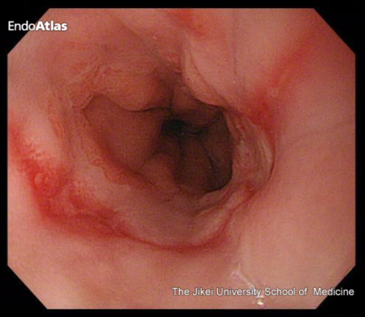 上部消化管内視鏡検査（胃カメラ）