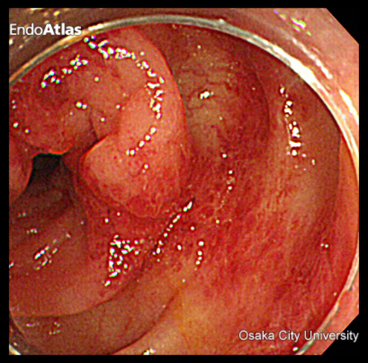 虚血性腸炎の大腸内視鏡検査写真