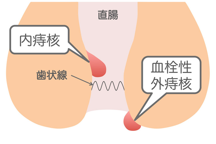 痔核（いぼ痔）のイメージイラスト