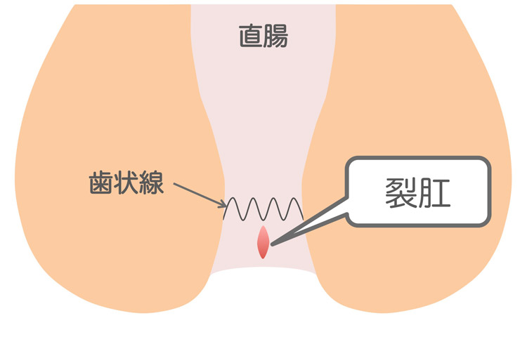 裂肛（切れ痔）のイメージイラスト