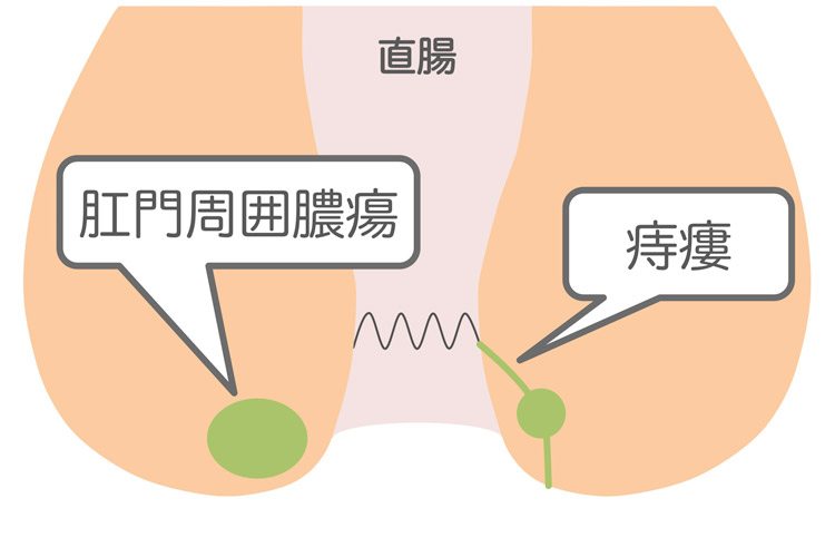 痔瘻・肛門周囲膿瘍のイメージイラスト