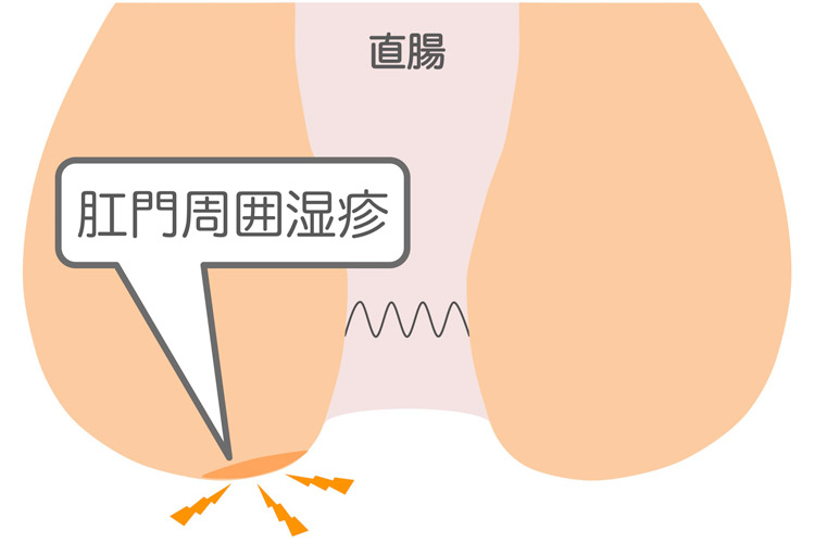 肛門周囲湿疹のイメージイラスト