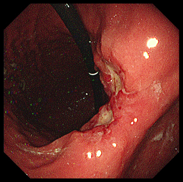 胃がんの内視鏡検査写真