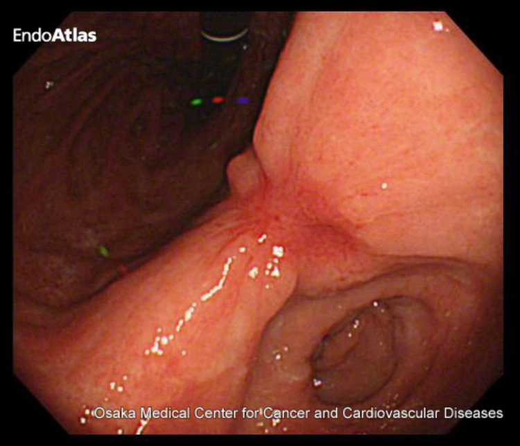 【早期胃がんの内視鏡検査写真】（OLYMPUS EndoAtlasより引用）