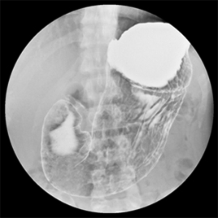 【胃透視検査（バリウム検査）の写真】（日本消化器内視鏡学会HPより引用）