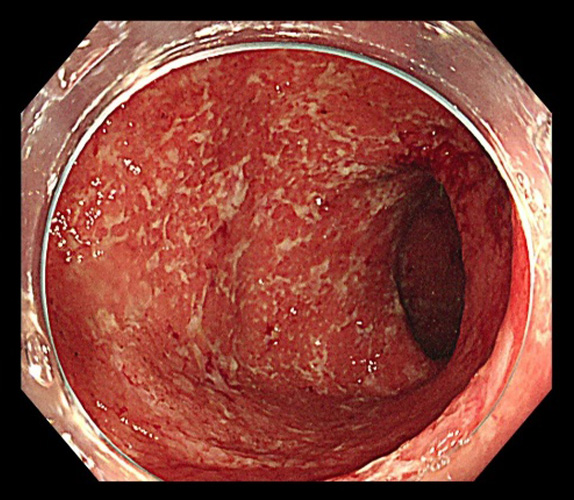 潰瘍性大腸炎とは？のイメージ画像