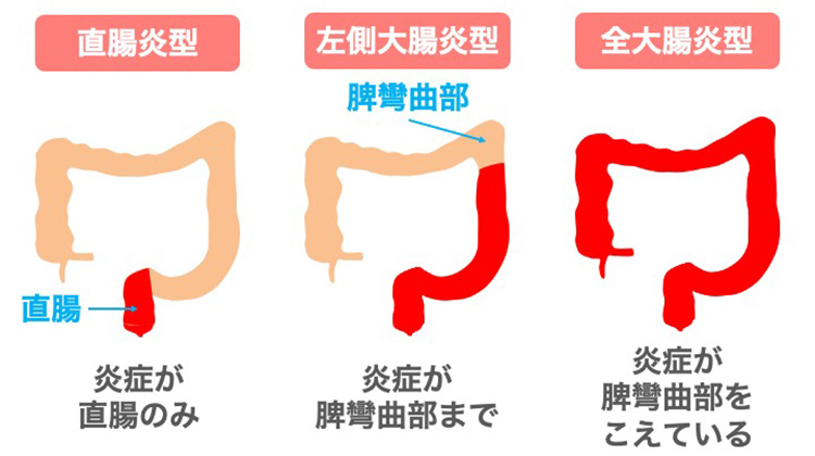 病変の拡がりによる分類